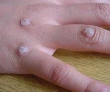 上環(huán)診斷方法和檢查項(xiàng)目