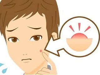痘痘的發(fā)病病因