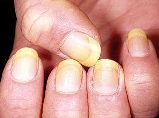 處女膜修補(bǔ)是怎么引起的