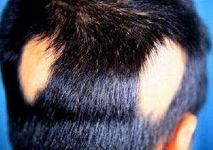 人流術(shù)后康復(fù)的發(fā)病原因